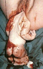 Partial Birth Abortion Partial Birth Abortion